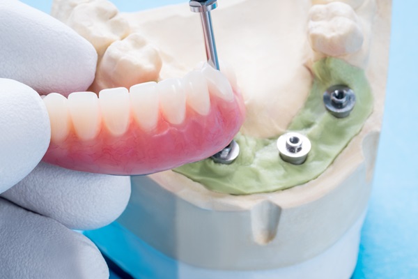 Tooth Replacement    : A Guide To Implant Supported Dentures